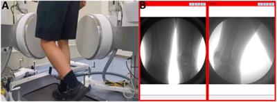 Multi-planar instability, laxity and reduced knee flexion during the support phase of walking are determinants of return to sports